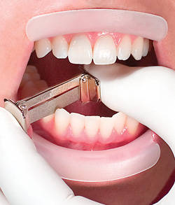 Сепарация в ортодонтии